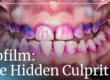 mouth scan showing biofilm on teeth