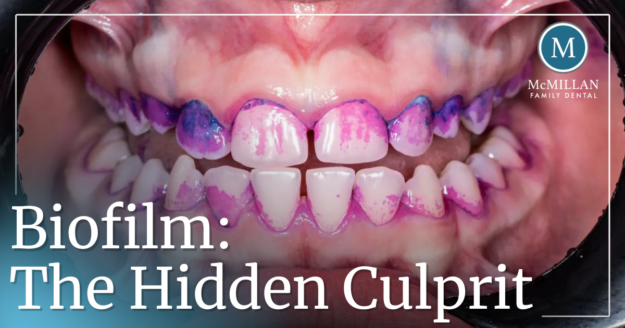 Biofilm: The Hidden Culprit mouth scan showing biofilm on teeth