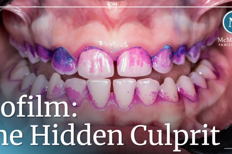 mouth scan showing biofilm on teeth