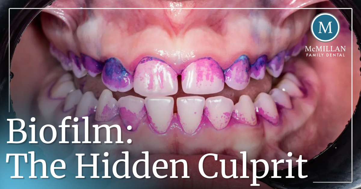 Biofilm: The Hidden Culprit mouth scan showing biofilm on teeth